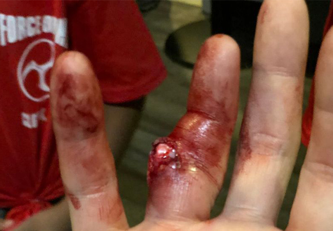 mma-blessure-63d024c2324ef